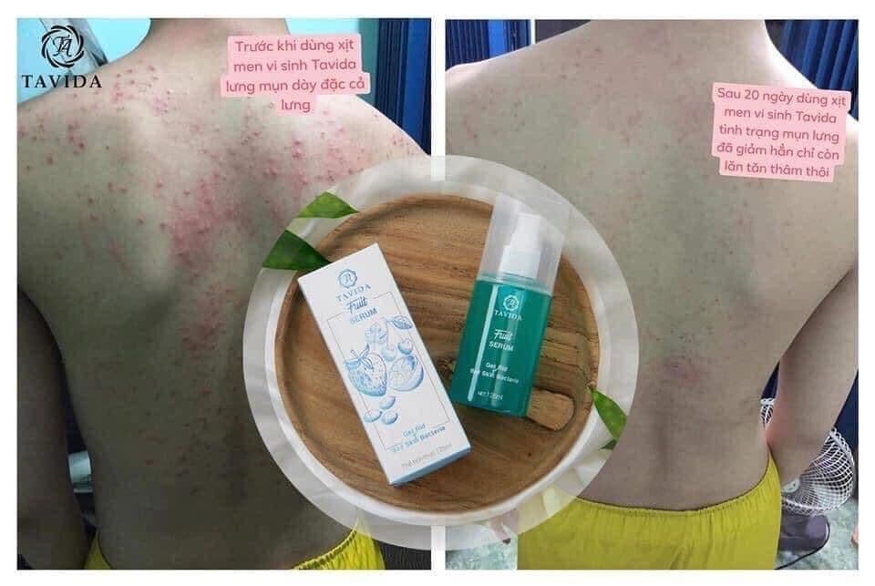 [ rẻ nhất sàn ] XỊT LỢI KHUẨN SERUM TRÁI CÂY - MEN VI SINH TAVIDA ĐÁNH BAY SẠCH MỤN LƯNG VIÊM NANG LÔNG MẨN NGỨA RÔM SẢY DỊ ỨNG