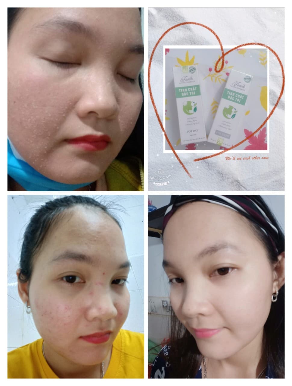 SERUM MỤN TAVIDA TÁI TẠO DA FOR DAY- nên dùng đủ bộ ngày đêm da nhanh đẹp