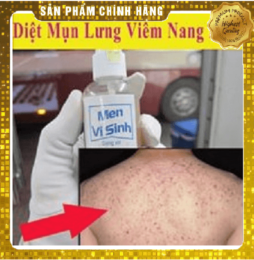 SERUM TRÁI CÂY - XỊT MEN VI SINH TAVIDA 100ml DỨT ĐIỂM SẠCH MỤN LƯNG VIÊM NANG LÔNG MẨN NGỨA HĂM TẢ Ở NGƯỜI LỚN VÀ TRẺ NHỎ