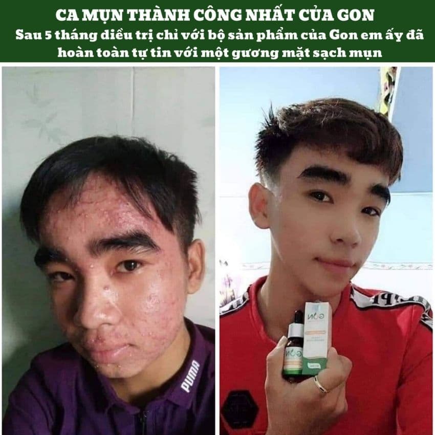 [BIGSALE] COMBO 2 SERUM GON ĐÁNH BAY MỤN THIÊN NHIÊN [CHÍNH HÃNG] DƯỠNG DA MỜ NÁM HẾT THÂM