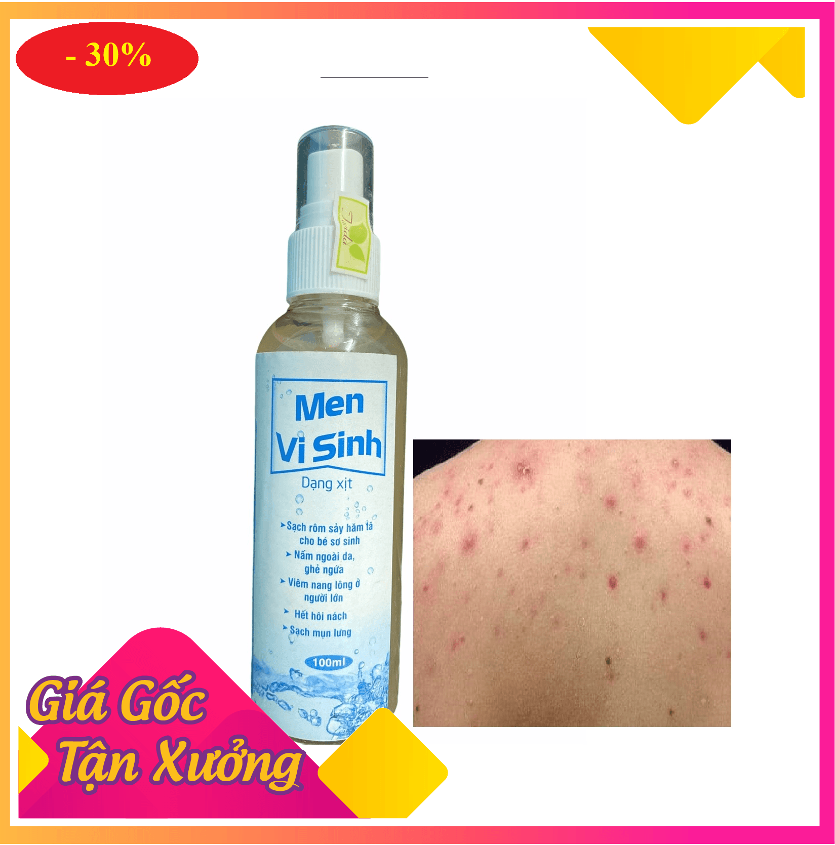 XỊT MEN VI SINH ( SERUM TRÁI CÂY LÊN MEN ) ĐÁNH TAN NỖI LÔ MỤN LƯNG NGỰC VIÊM NANG LÔNG NẤM DA MẨN ĐỎ