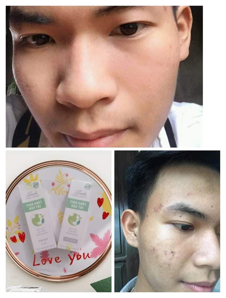 SERUM TÁI TẠO SẠCH MỤN THÂM TAVIDA LOẠI FOR NIGHT- dùng theo hướng dẫn da nhanh đẹp hơn